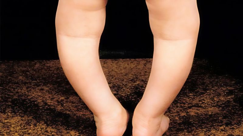 Dấu hiệu dễ nhận biết nhất của chân vòng kiềng là khi trẻ đứng thẳng