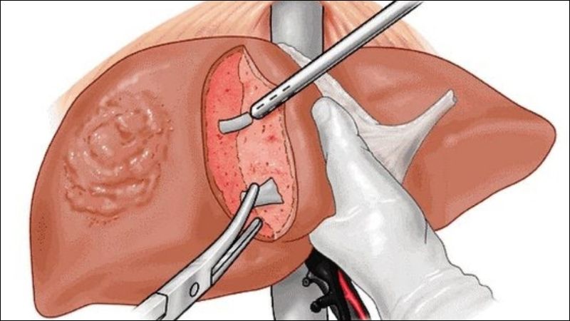 Ghép gan có thể được cân nhắc ở người viêm gan D biến chứng ung thư gan
