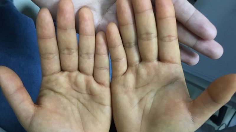 Vàng da có thể là biểu hiện của viêm gan D