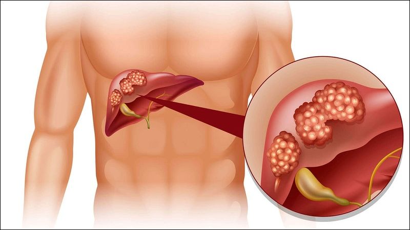 Ung thư gan là một biến chứng có thể xảy ra ở người viêm gan D