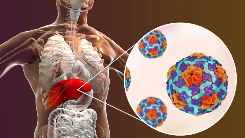 Viêm gan E là tình trạng viêm gan do virus viêm gan E gây ra