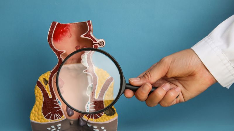 Trĩ ngoại dễ dàng quan sát bằng mắt thường Trĩ ngoại dễ dàng quan sát bằng mắt thường