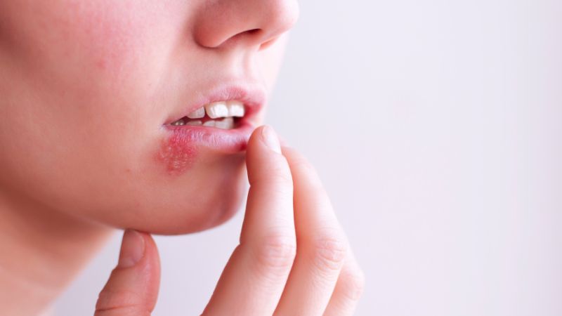 Virus gây herpes môi sẽ phát triển khi gặp điều kiện thuận lợi Virus gây herpes môi sẽ phát triển khi gặp điều kiện thuận lợi