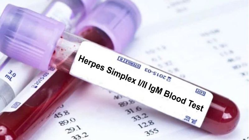 Bác sĩ có thể chỉ định xét nghiệm máu để xác định kháng thể HSV Bác sĩ có thể chỉ định xét nghiệm máu để xác định kháng thể HSV