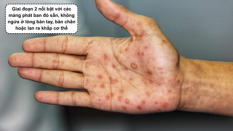 Nữ giới thường xuất hiện các mảng phát ban đỏ sần ở giai đoạn thứ phát