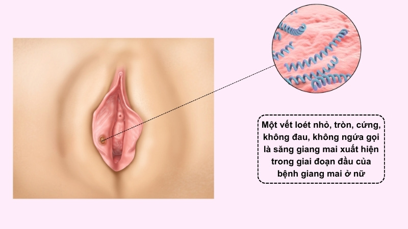 Nữ giới thường xuất hiện các vết loét nhỏ ở bộ phận sinh dục giai đoạn đầu