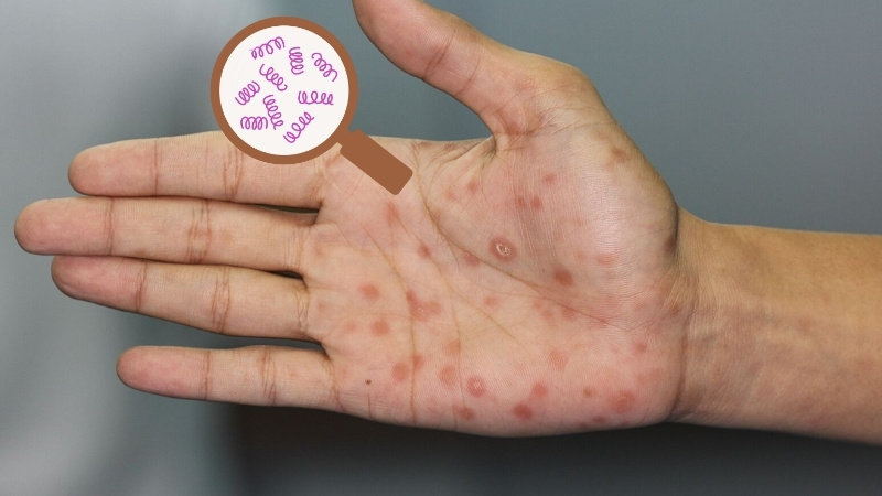 Giang mai ở nam giới là bệnh lây truyền qua đường tình dục do xoắn khuẩn gây ra