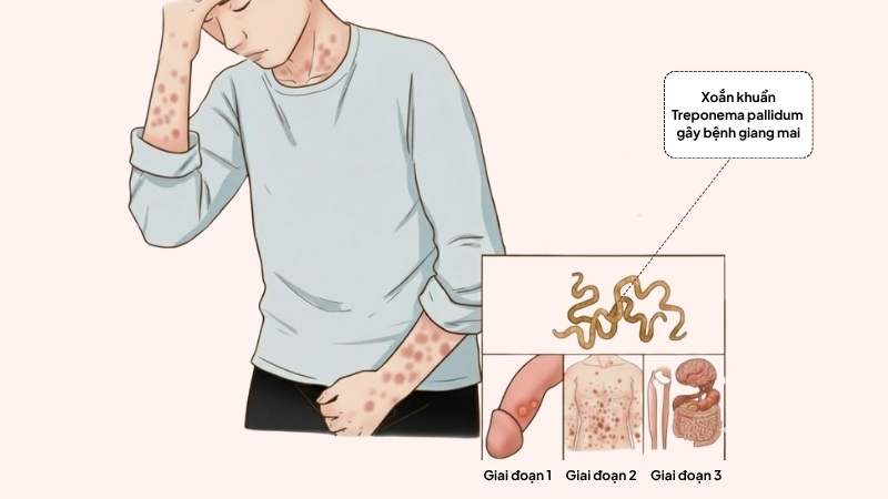 Giang mai phát triển và gây bệnh qua 3 giai đoạn chính