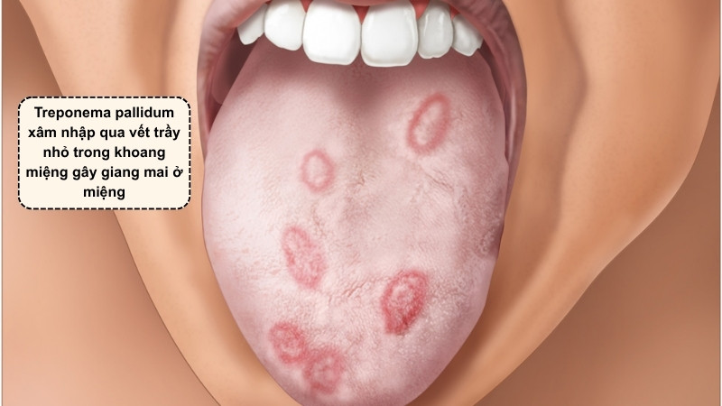 Xoắn khuẩn xâm nhập qua lớp niêm mạc mỏng hoặc vết trầy nhỏ trong khoang miệng gây bệnh Xoắn khuẩn xâm nhập qua lớp niêm mạc mỏng hoặc vết trầy nhỏ trong khoang miệng gây bệnh