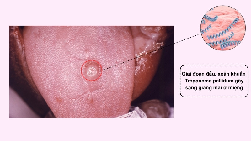 Săng giang mai xuất hiện ở giai đoạn đầu của bệnh Săng giang mai xuất hiện ở giai đoạn đầu của bệnh