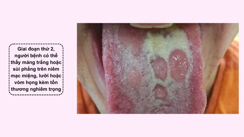 Giang mai giai đoạn 2 gây mảng trắng hoặc sùi phẳng ở niêm mạc miệng Giang mai giai đoạn 2 gây mảng trắng hoặc sùi phẳng ở niêm mạc miệng