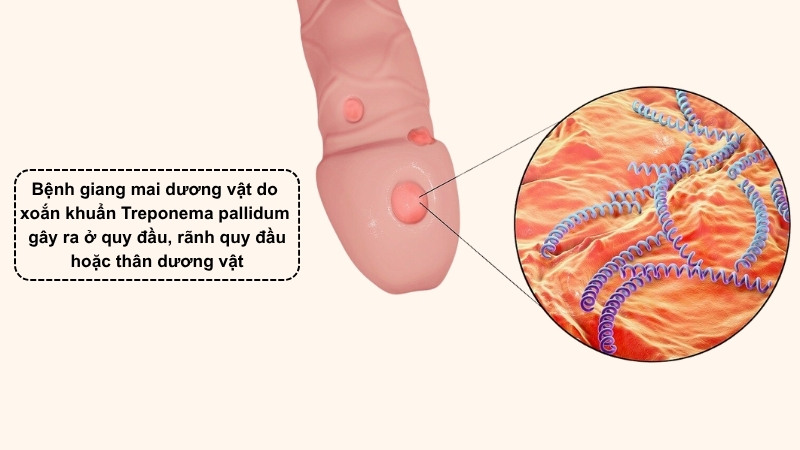 Giang mai dương vật là bệnh lây qua đường tình dục do Treponema pallidum gây ra ở quy đầu, rãnh và thân dương vật