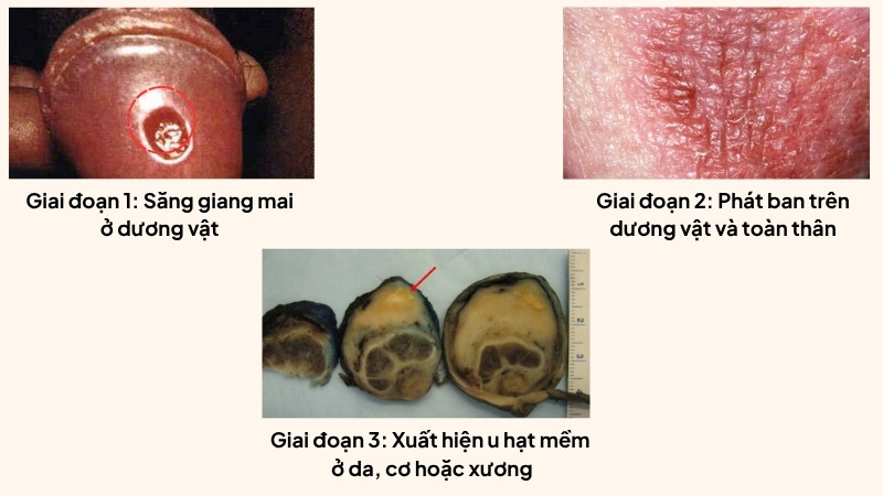Một số dấu hiệu nhận biết giang mai dương vật qua từng giai đoạn