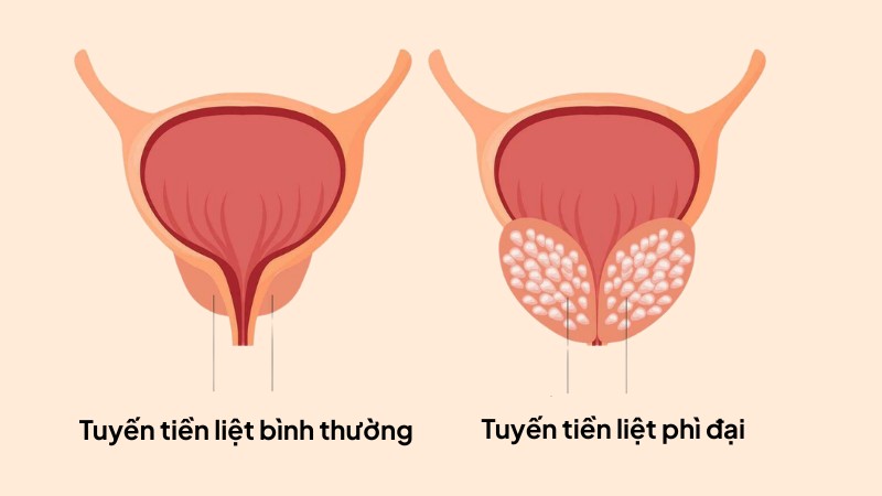 Phì đại tuyến tiền liệt thường gặp ở nam giới trên 50 tuổi