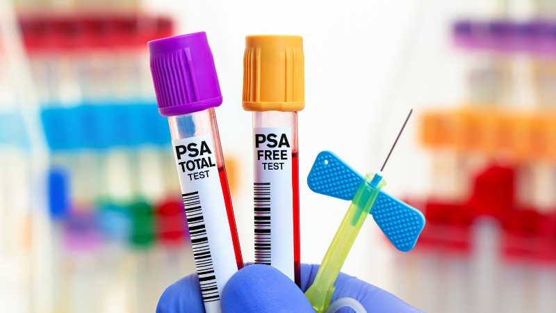 Bác sĩ có thể thực hiện xét nghiệm PSA để đo nồng độ protein do tuyến tiền liệt sản xuất ra