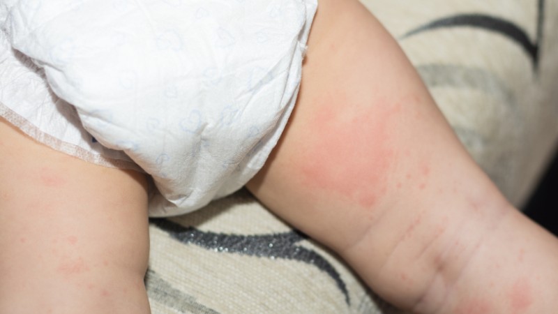 Hăm tã là một dạng viêm da khu trú ở vùng mặc tã Hăm tã là một dạng viêm da khu trú ở vùng mặc tã