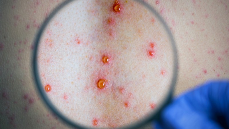 Bạn cần khám bác sĩ khi mụn lưng đột ngột xuất hiện với số lượng lớn