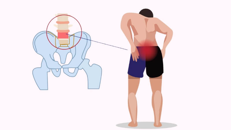 Cảm giác đau âm ỉ, nhói hoặc đau dữ dội ở vùng cuối cột sống Cảm giác đau âm ỉ, nhói hoặc đau dữ dội ở vùng cuối cột sống