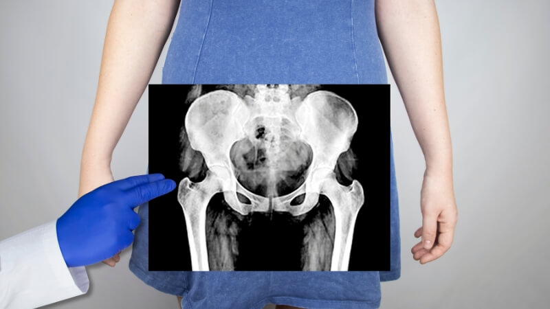 Bác sĩ có thể tiến hành chụp X-quang để xác định tình trạng đau xương cụt Bác sĩ có thể tiến hành chụp X-quang để xác định tình trạng đau xương cụt