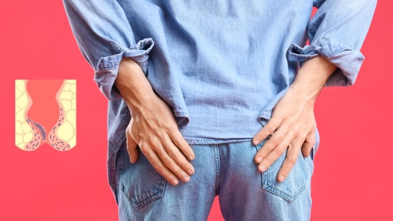 Các búi trĩ có thể sa ra ngoài nếu không điều trị kịp thời Các búi trĩ có thể sa ra ngoài nếu không điều trị kịp thời