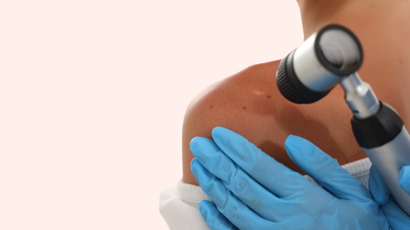 Bác sĩ có thể chỉ định sinh thiết da để khẳng định chính xác tình trạng bệnh
