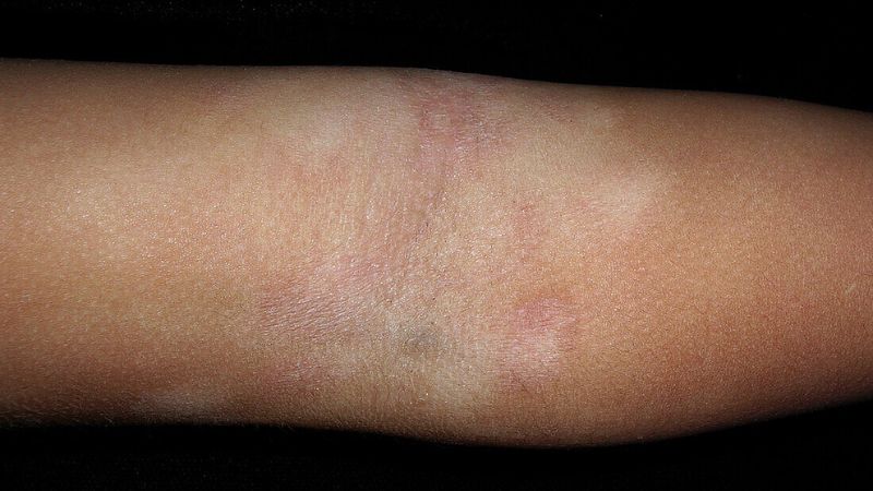 Vảy phấn trắng đặc trưng bởi c&aacute;c mảng da s&aacute;ng m&agrave;u hơn v&ugrave;ng da xung quanh