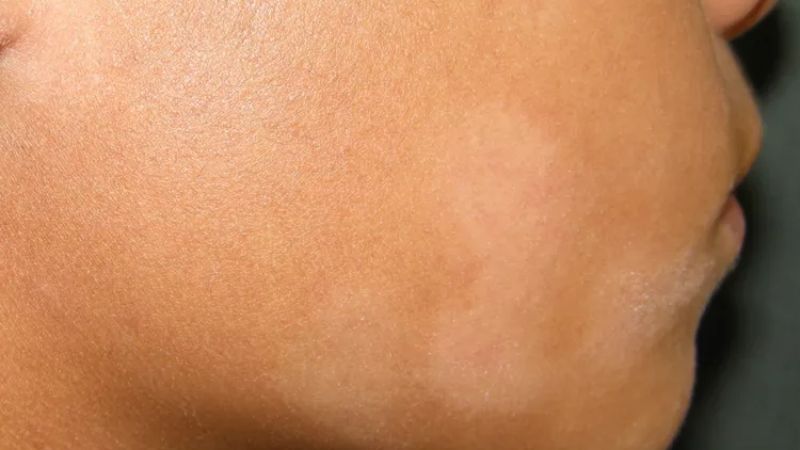 Vảy phấn trắng xuất hiện phổ biến ở v&ugrave;ng da mặt
