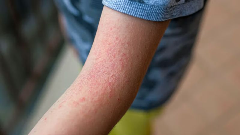 Những người c&oacute; tiền sử vi&ecirc;m da cơ địa c&oacute; nguy cơ cao bị vảy phấn trắng