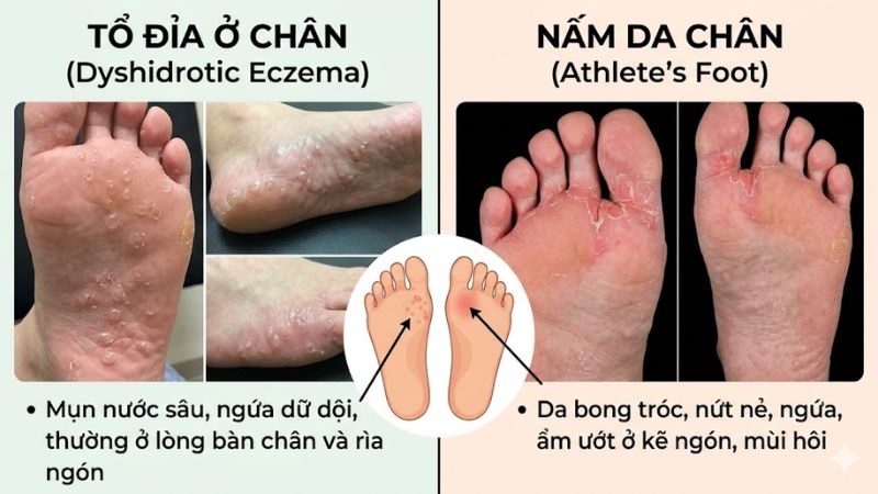 C&aacute;ch ph&acirc;n biệt tổ đỉa ở ch&acirc;n v&agrave; nấm da ch&acirc;n