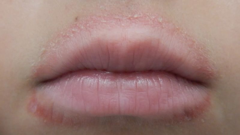 Vi&ecirc;m da quanh miệng l&agrave; một dạng vi&ecirc;m da mạn t&iacute;nh thường xuất hiện ở v&ugrave;ng da quanh miệng