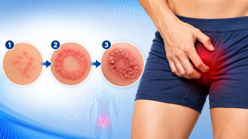 H&igrave;nh ảnh nấm bẹn qua từng giai đoạn