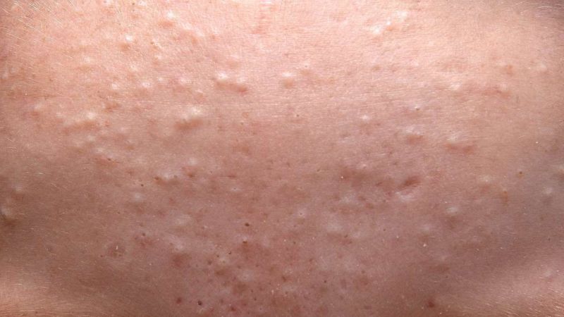 Mụn đầu trắng là một dạng mụn không viêm, khi phần nhân mụn có màu trắng hoặc trắng ngà