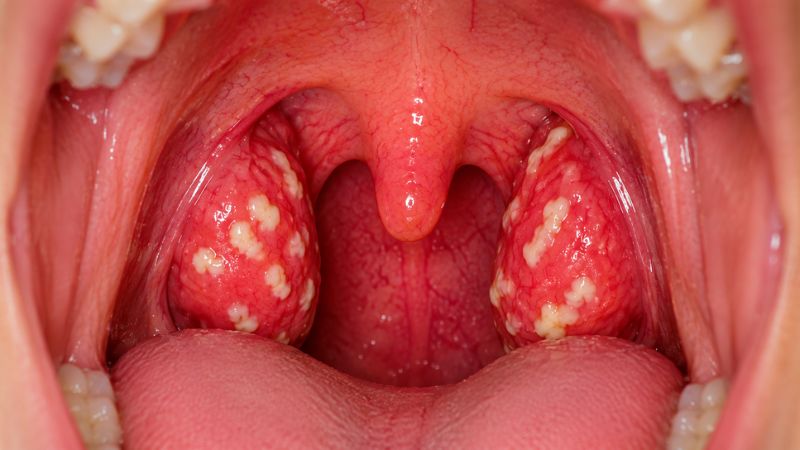 Viêm amidan hốc mủ là một dạng viêm amidan mạn tính xảy ra khi các khe bên trong amidan bị viêm kéo dài Viêm amidan hốc mủ là một dạng viêm amidan mạn tính xảy ra khi các khe bên trong amidan bị viêm kéo dài