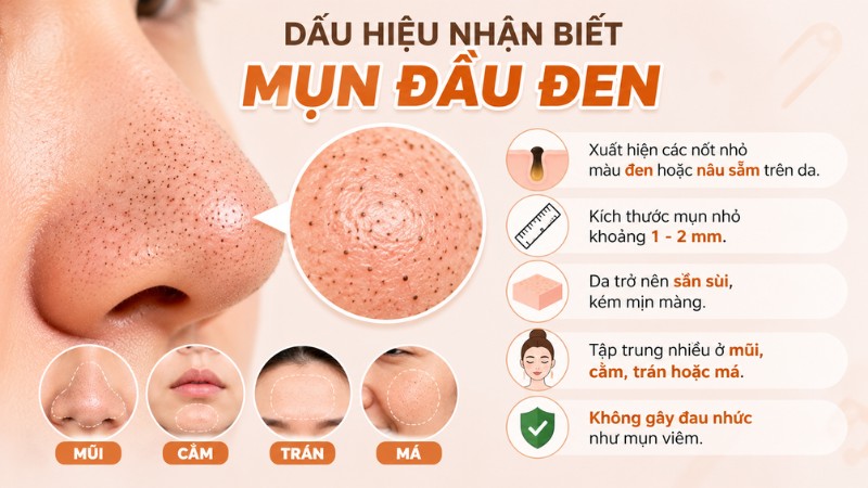 Các dấu hiệu giúp bạn nhận biết mụn đầu đen Các dấu hiệu giúp bạn nhận biết mụn đầu đen