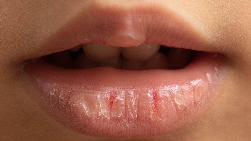 Khô miệng xảy ra khi khoang miệng đang bị thiếu nước bọt Khô miệng xảy ra khi khoang miệng đang bị thiếu nước bọt