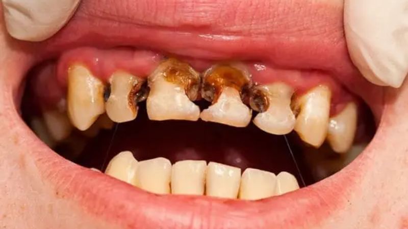 Sâu răng lan tỏa là dấu hiệu cảnh báo người bệnh nên đi gặp bác sĩ Sâu răng lan tỏa là dấu hiệu cảnh báo người bệnh nên đi gặp bác sĩ