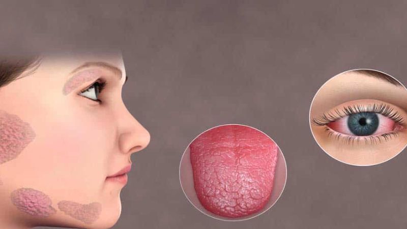 Hội chứng Sjogren có thể gây khô miệng Hội chứng Sjogren có thể gây khô miệng