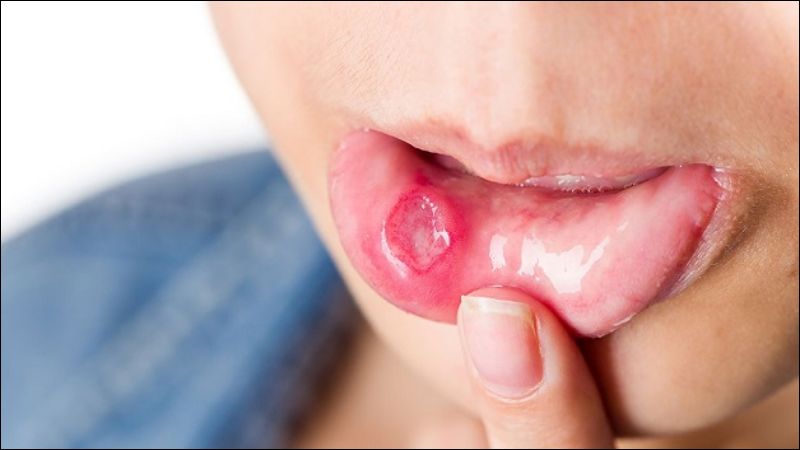 Viêm loét niêm mạc miệng là biến chứng hay gặp khi khô miệng nghiêm trọng Viêm loét niêm mạc miệng là biến chứng hay gặp khi khô miệng nghiêm trọng