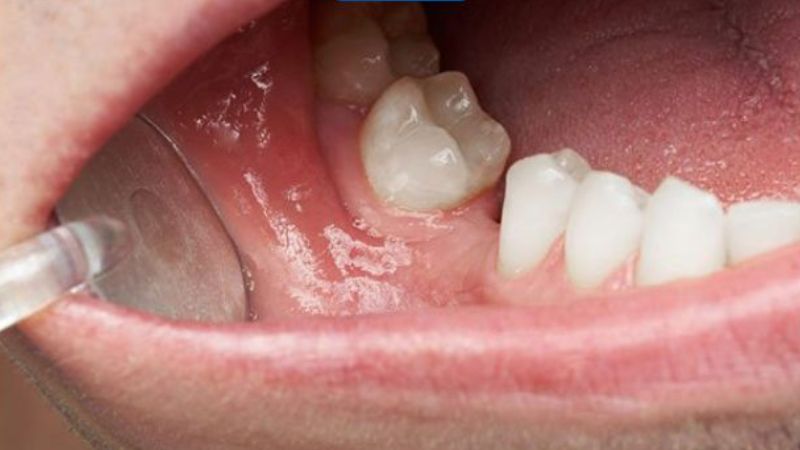 Khô môi và niêm mạc miệng là dấu hiệu quan trọng giúp chẩn đoán khô miệng Khô môi và niêm mạc miệng là dấu hiệu quan trọng giúp chẩn đoán khô miệng
