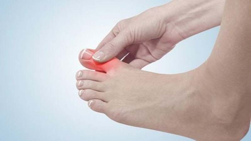 Bệnh gout có thể gây sưng đau ở ngón chân cái