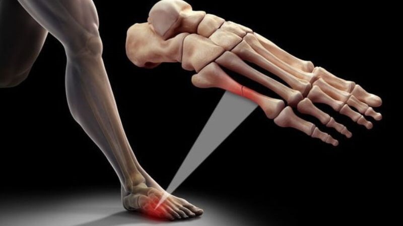 Gãy xương cũng là một nguyên nhân gây đau bàn chân
