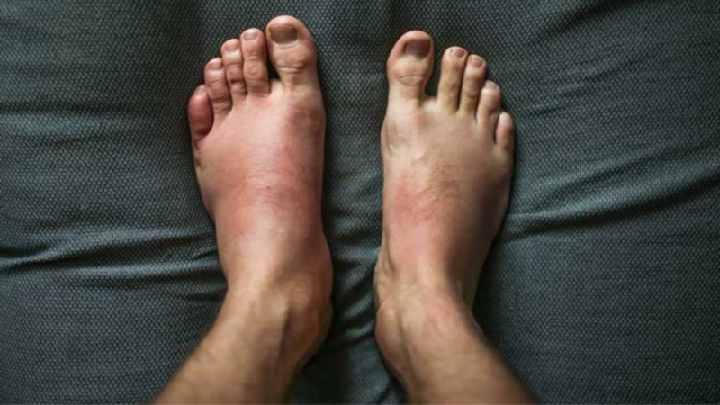 Viêm xương hoặc chấn thương cũng gây đau xương bàn chân