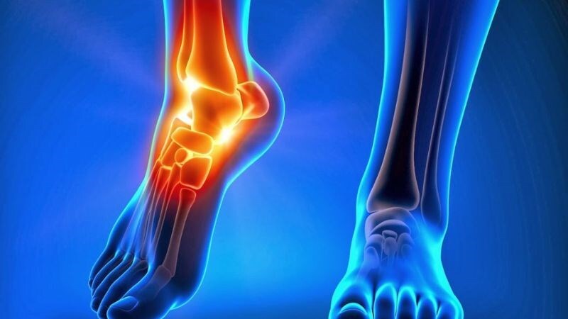 Sưng đau các khớp bàn chân có thể gặp ở bệnh nhân viêm khớp dạng thấp