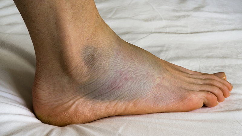 Bạn cần gặp bác sĩ khi đau bàn chân do chấn thương