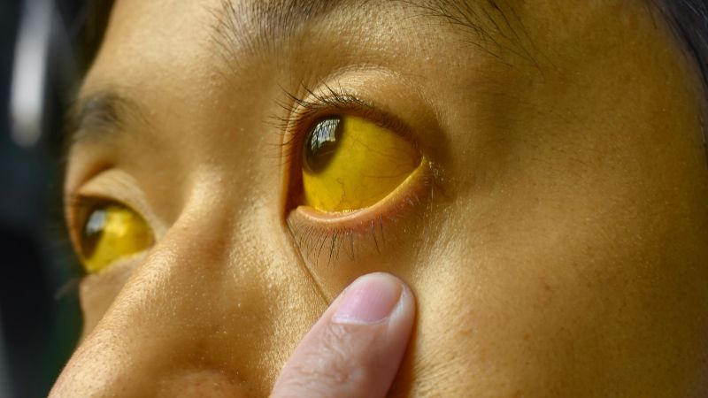 Đau bụng vùng hạ sườn phải kèm vàng da là một dấu hiệu cảnh báo Đau bụng vùng hạ sườn phải kèm vàng da là một dấu hiệu cảnh báo