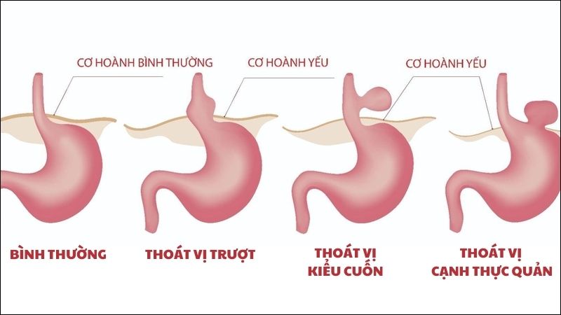 Thoát vị hoành gây đau vùng bụng trên rốn Thoát vị hoành gây đau vùng bụng trên rốn