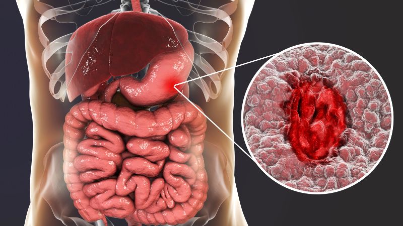 Viêm loét dạ dày có thể gây ra các cơn đau nhói vùng thượng vị Viêm loét dạ dày có thể gây ra các cơn đau nhói vùng thượng vị