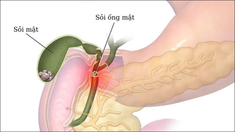Sỏi mật có thể gây đau vùng hạ sườn phải Sỏi mật có thể gây đau vùng hạ sườn phải