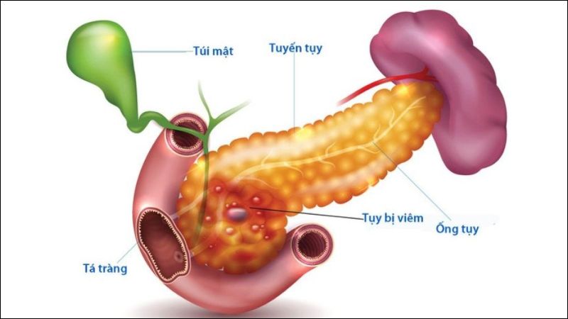 Viêm tụy cấp có thể biểu hiện bằng các cơn đau bụng dữ dội sau ăn Viêm tụy cấp có thể biểu hiện bằng các cơn đau bụng dữ dội sau ăn