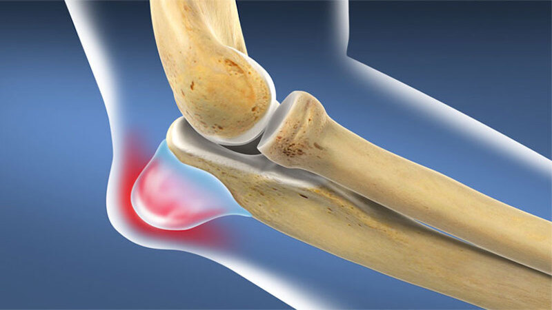 Viêm bao hoạt dịch vùng khuỷu tay có thể gây đau khuỷu tay